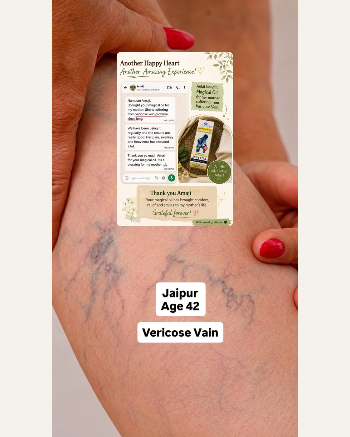 varicose_vein_same_size_no_mirror